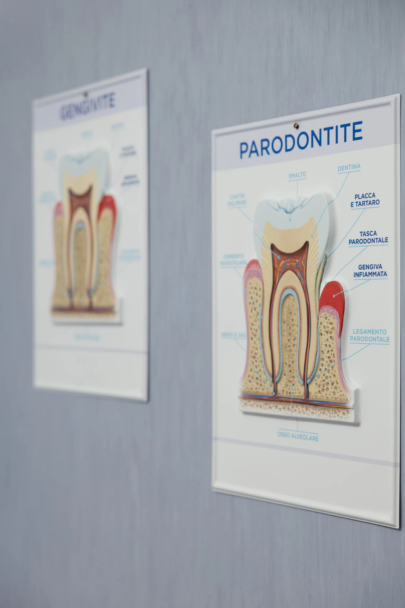 Parodontite Inquadramento parodontale - Nicola Ranieri Dental Clinic