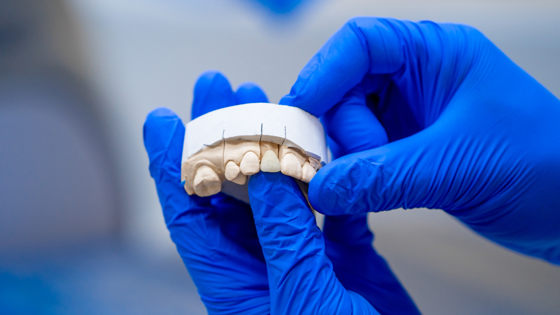 Protesi dentaria Protesi Dentaria impianto e riparazione - Nicola Ranieri Dental Clinic